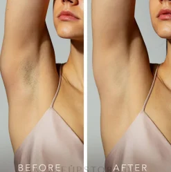 Photoepilator