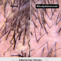 Shampoo gegen Schuppen